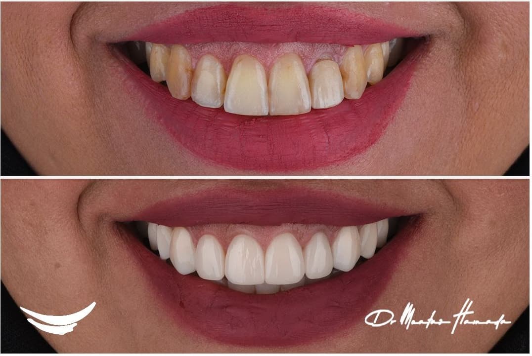 Before and after cosmetic dentistry transformation 2